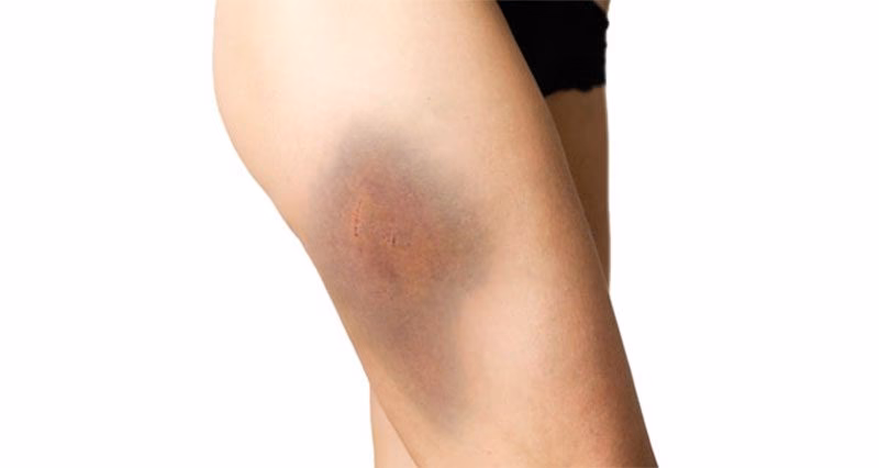 How do you treat a thigh contusion?