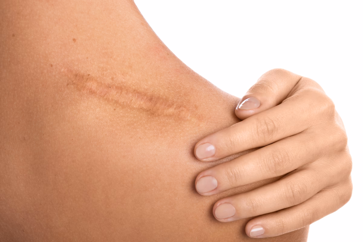How do surgical scars form?