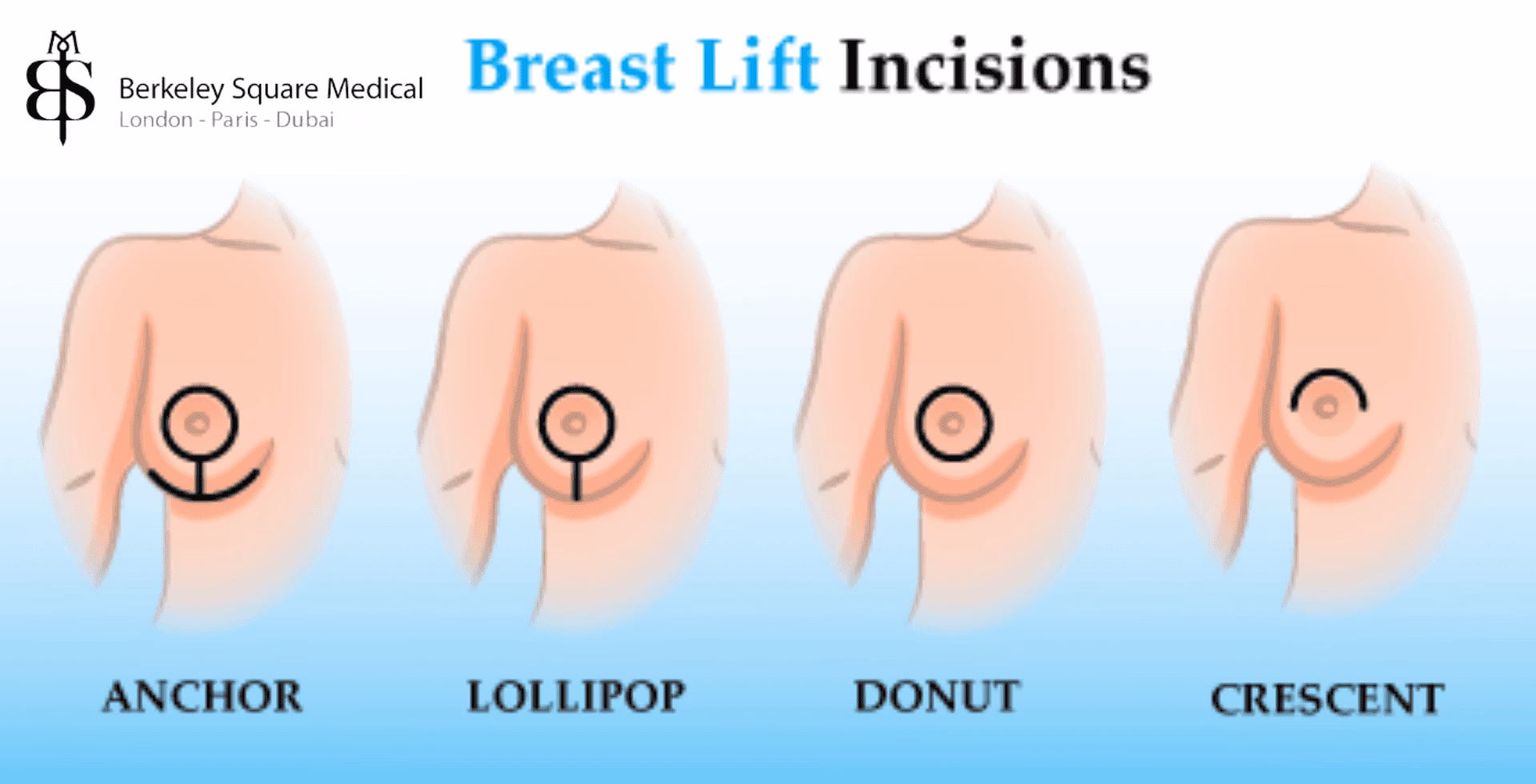 Does mastopexy cause scarring after breast lift surgery?