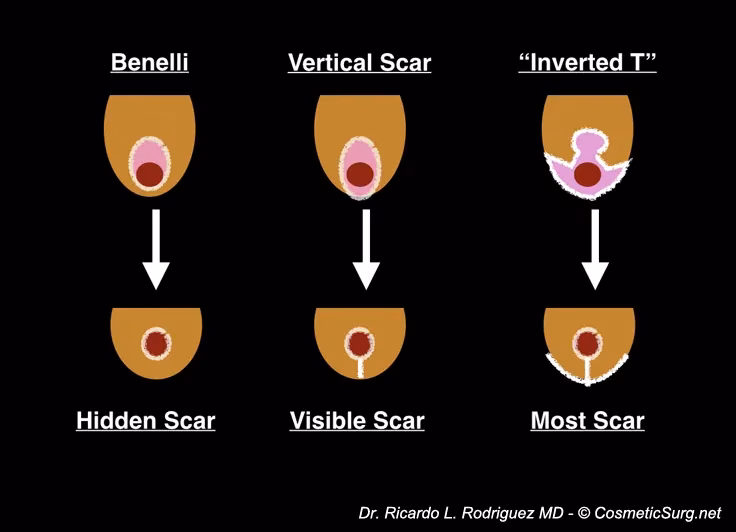 What are the different types of scars after breast lift surgery?