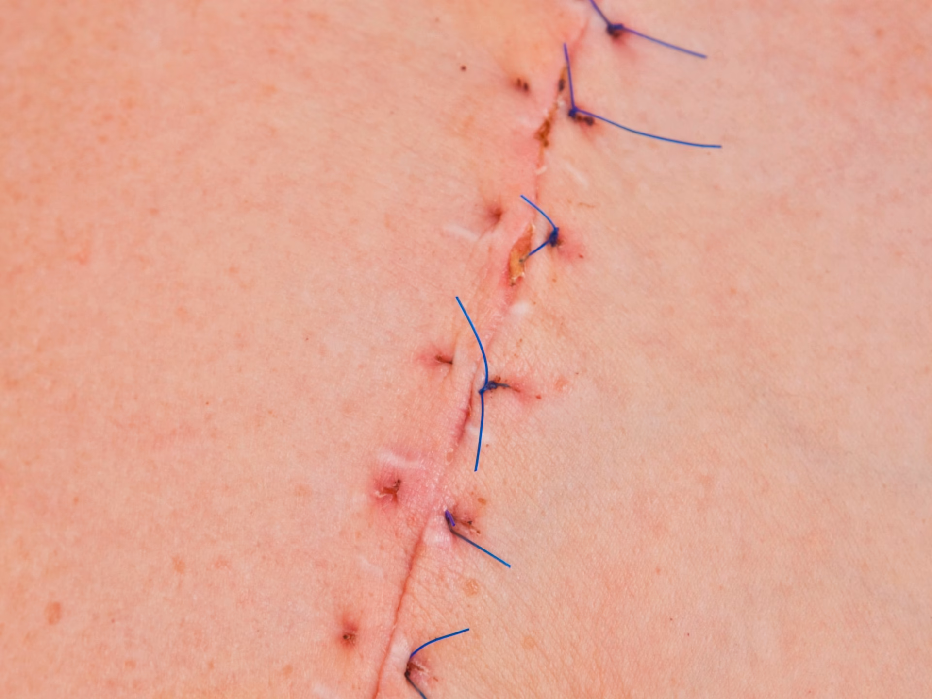 What should I do if I have a scar after surgery?