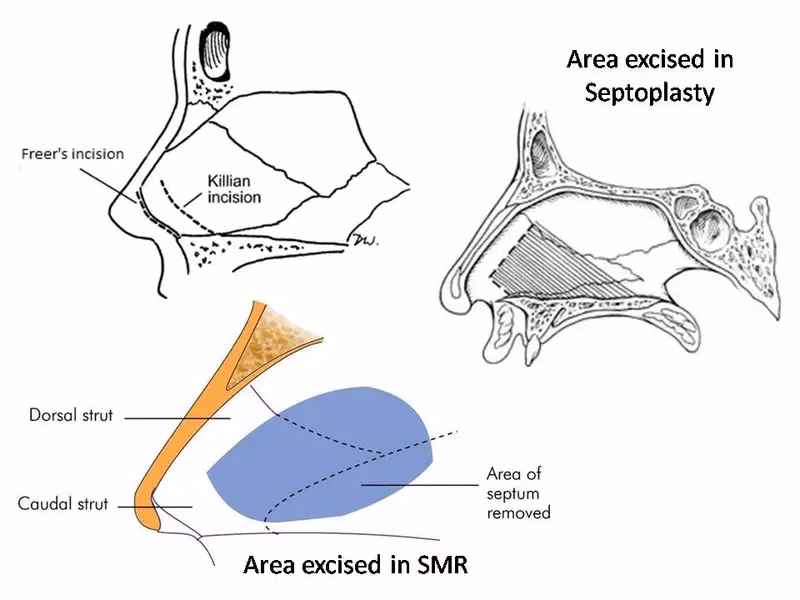 What is inferior turbinate resection (SMR)?