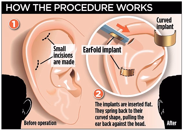 Is ear correction surgery safe?
