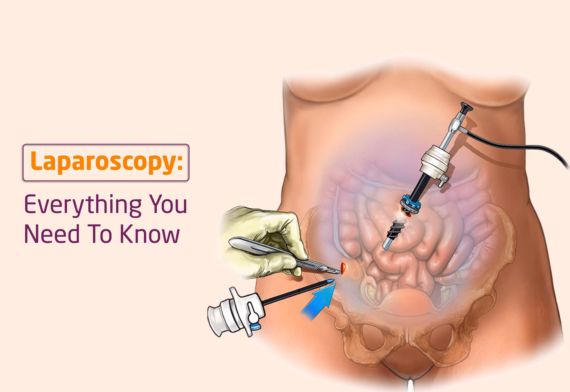 Can laparoscopic surgery be used to treat female infertility?