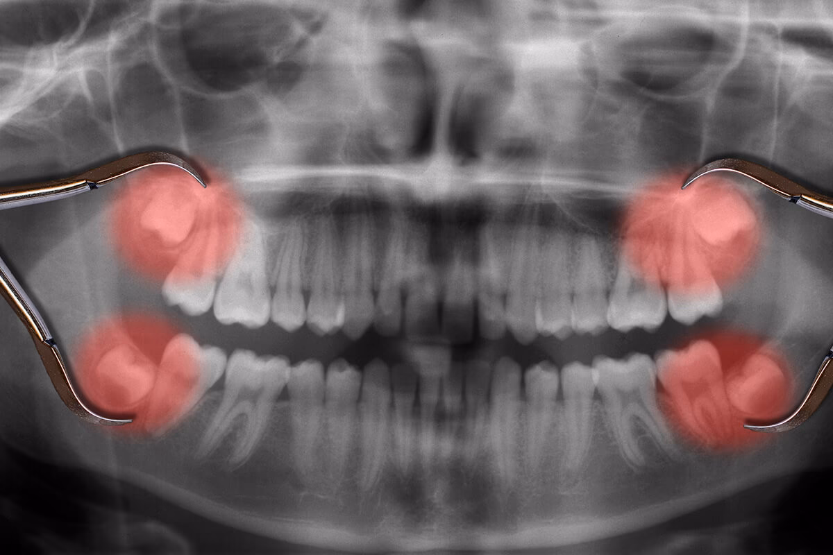 Can a wisdom tooth be removed?
