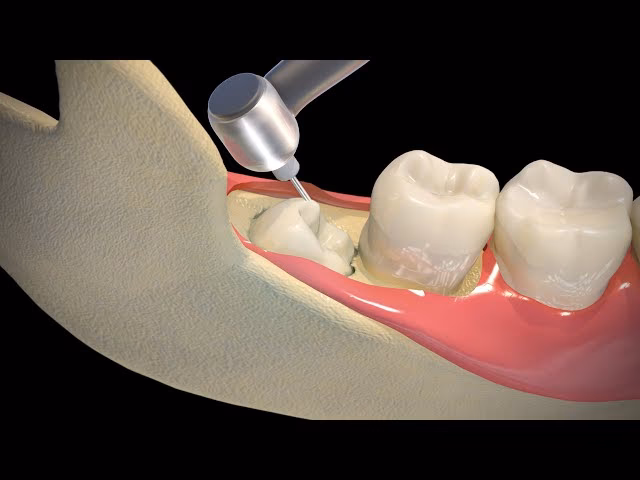 Can you talk after a wisdom tooth removal?