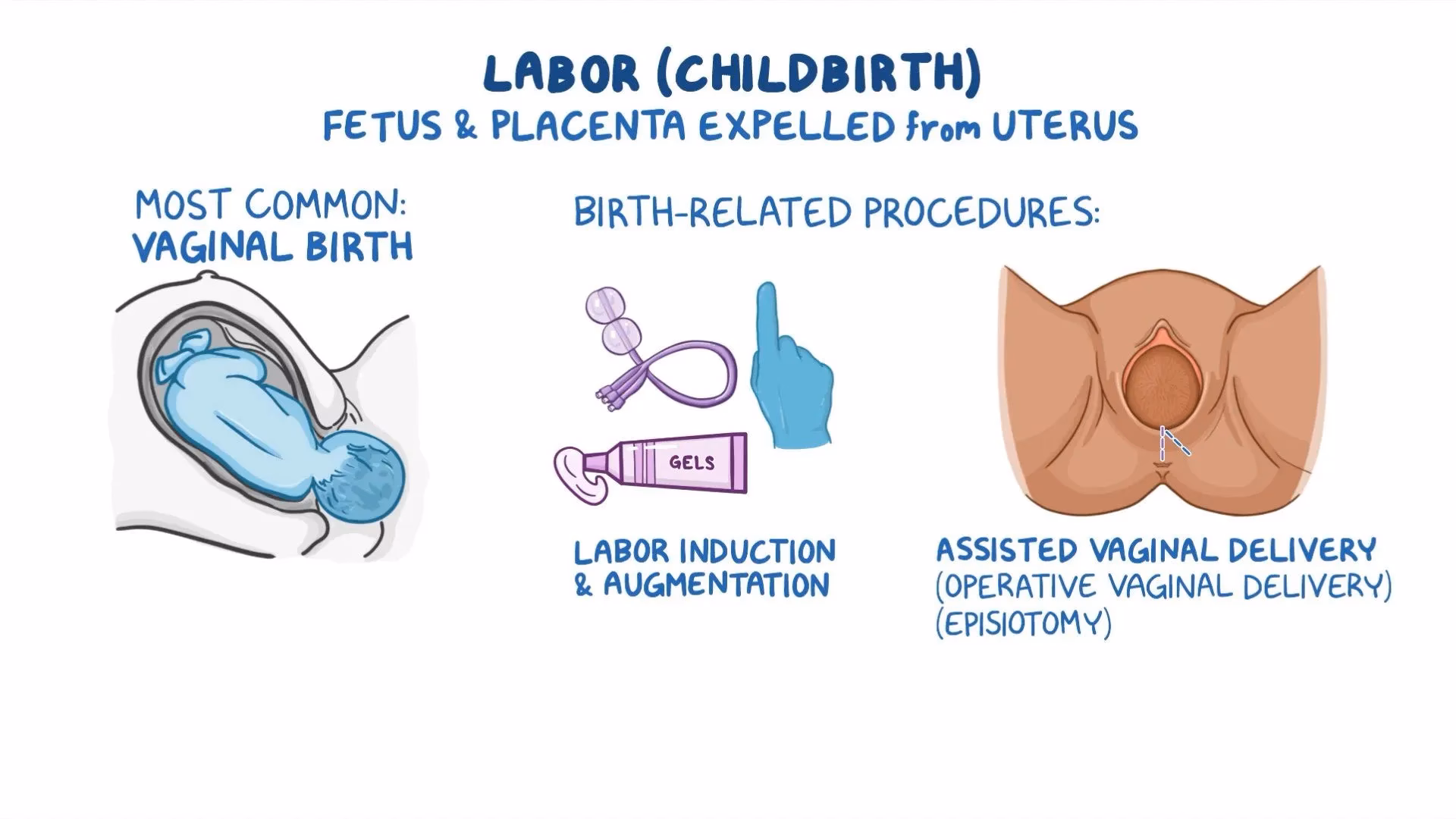 What is operative vaginal birth (OVB)?