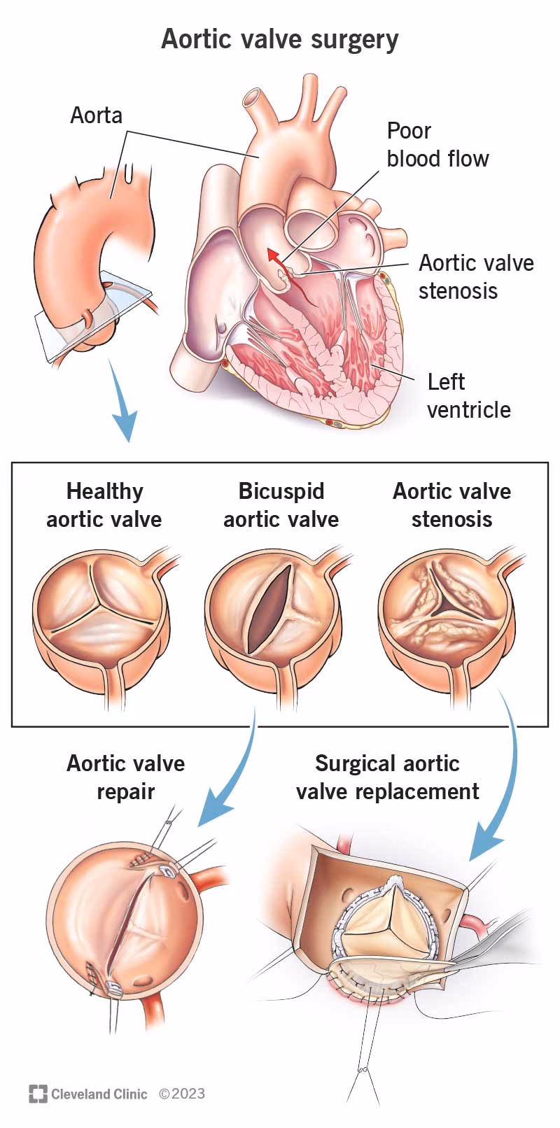 Does surgical aortic valve replacement improve survival?