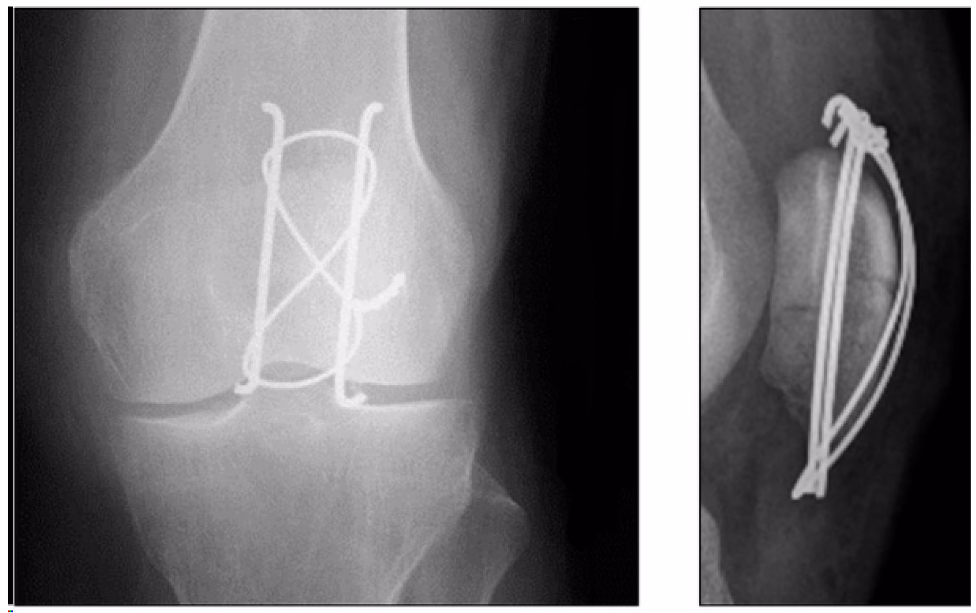 How to reduce patellofemoral problems?