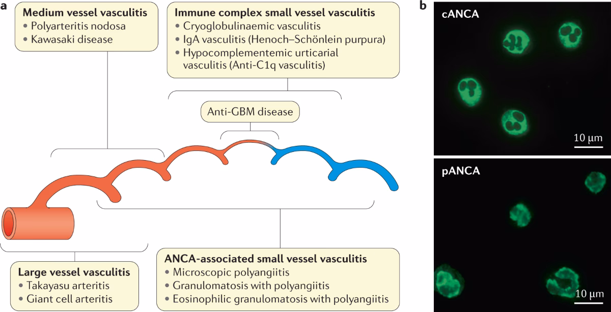 Can anti Pr3 ANCA be detected in patients with pulmonary tuberculosis?