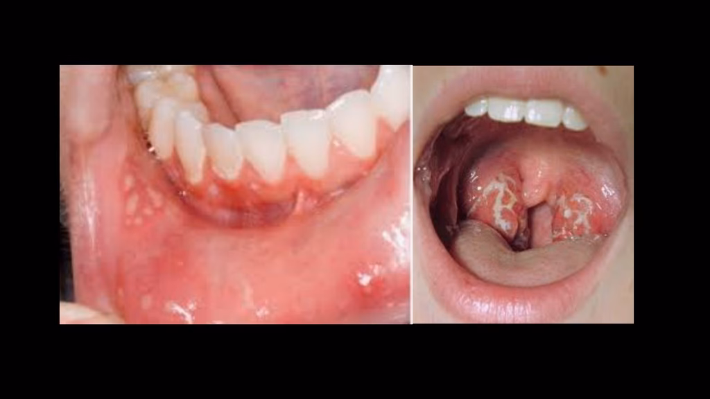 What is PFAPA syndrome?