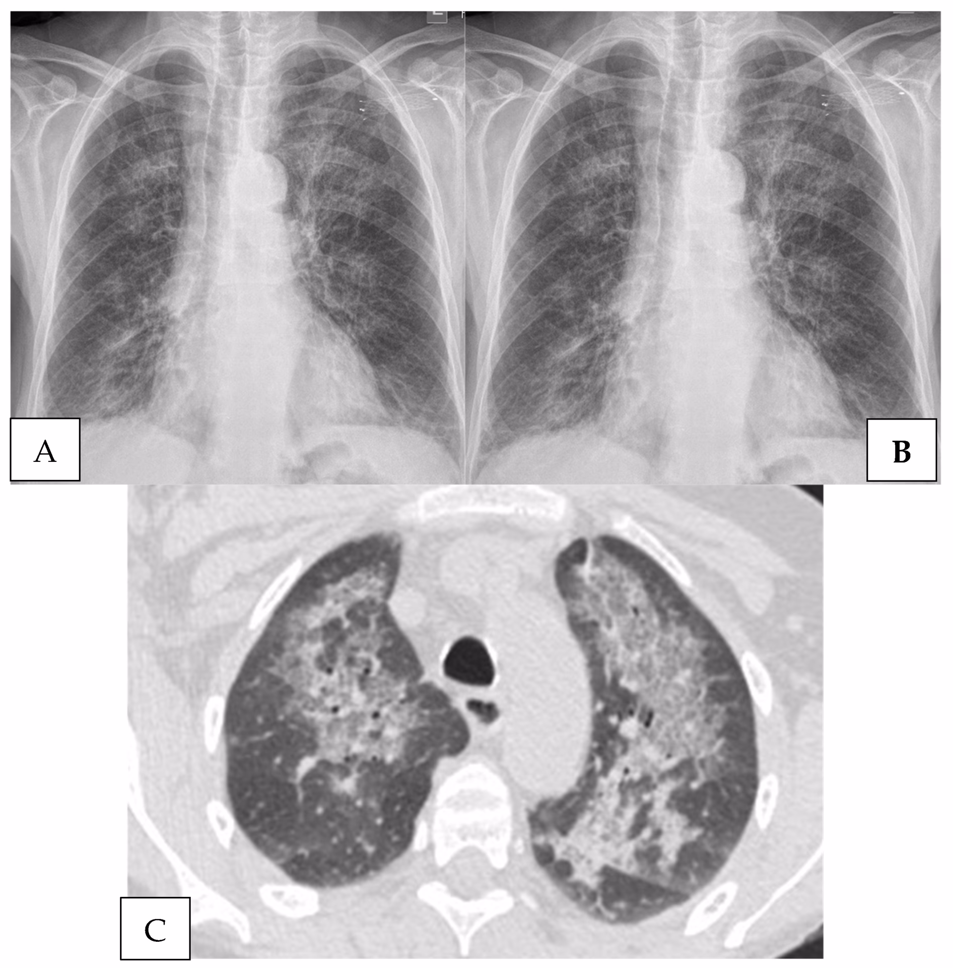 What is pulmonary Pneumocystis jirovecii infection?