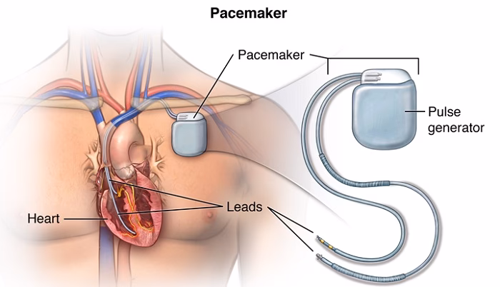 How much does a private cardiac pacemaker insertion surgery cost?