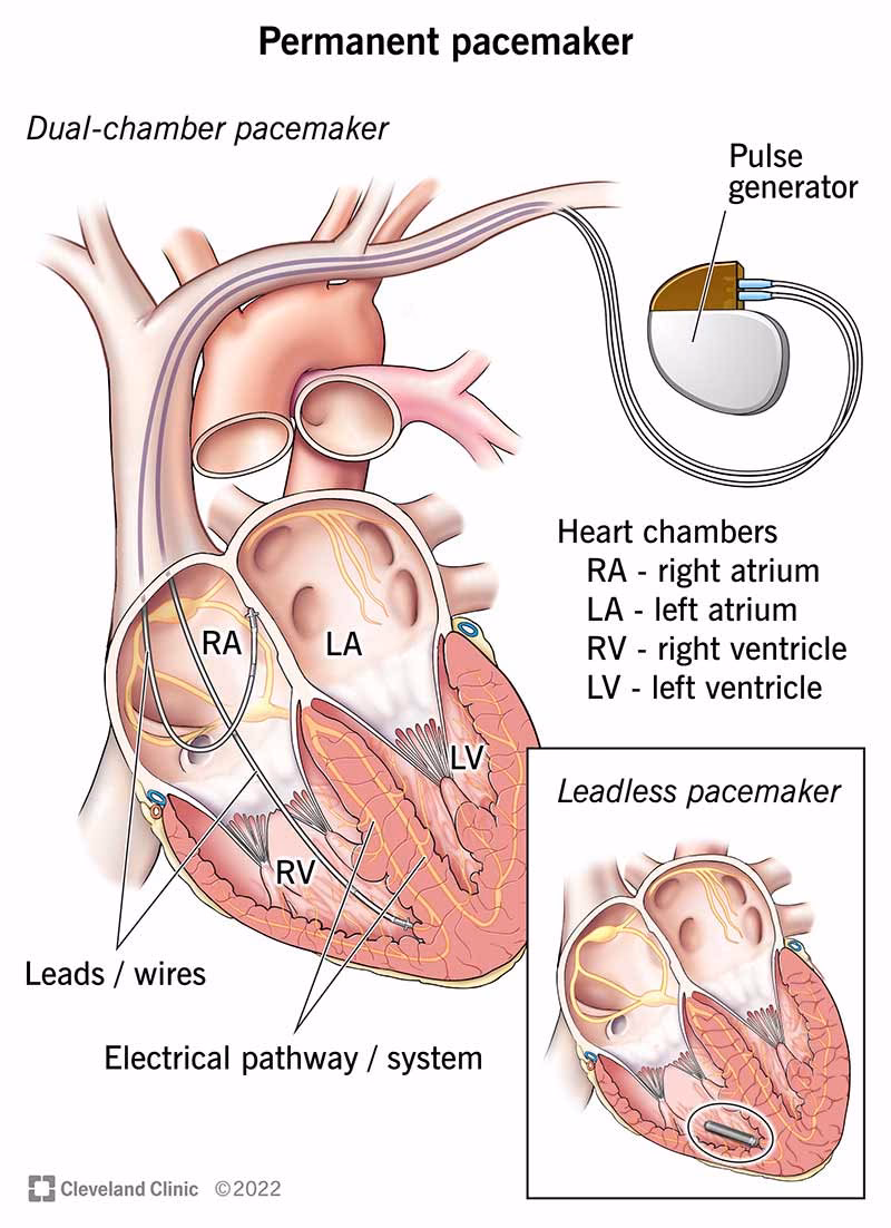 How long does it take to recover from pacemaker surgery?