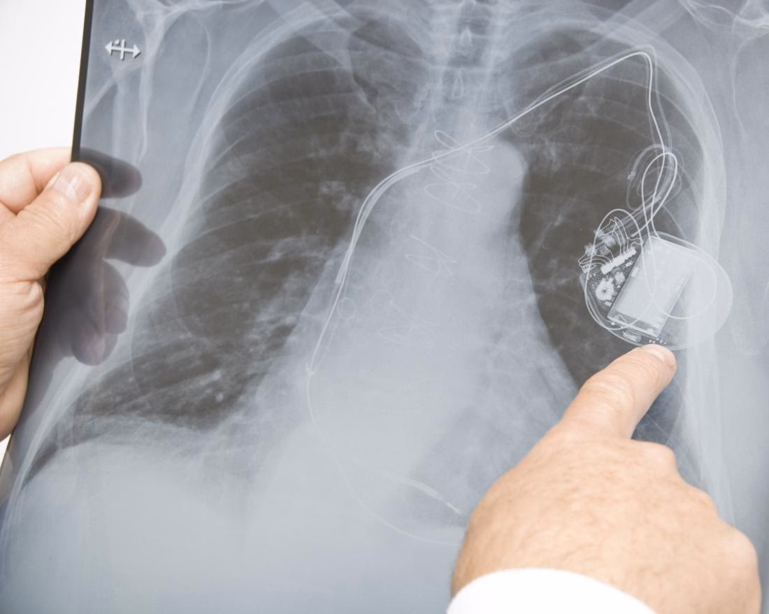 What are the complication of pacemaker implantation?