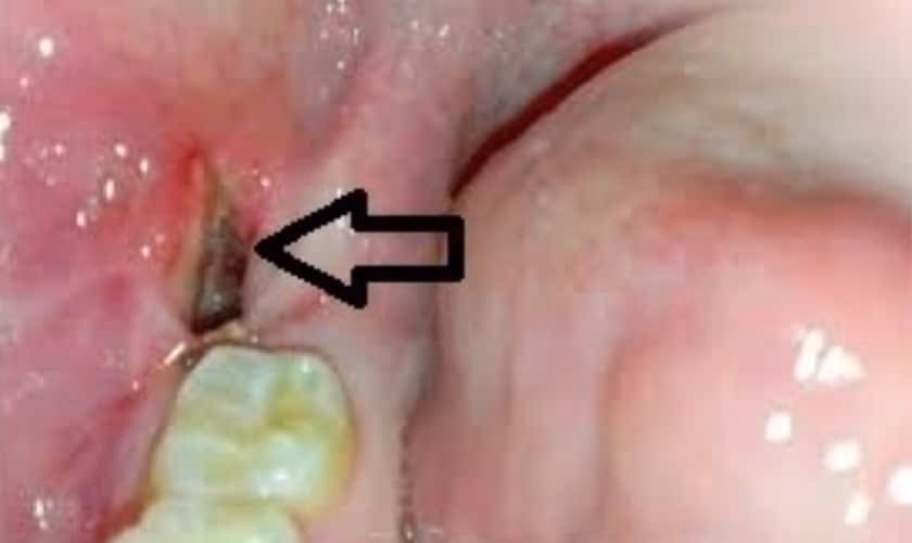 Is throbbing pain 5 days after wisdom teeth removal normal?