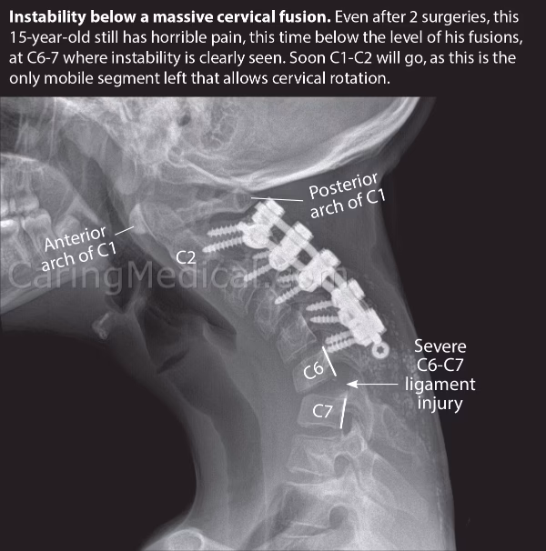Is neck pain a symptom of ACDF surgery?
