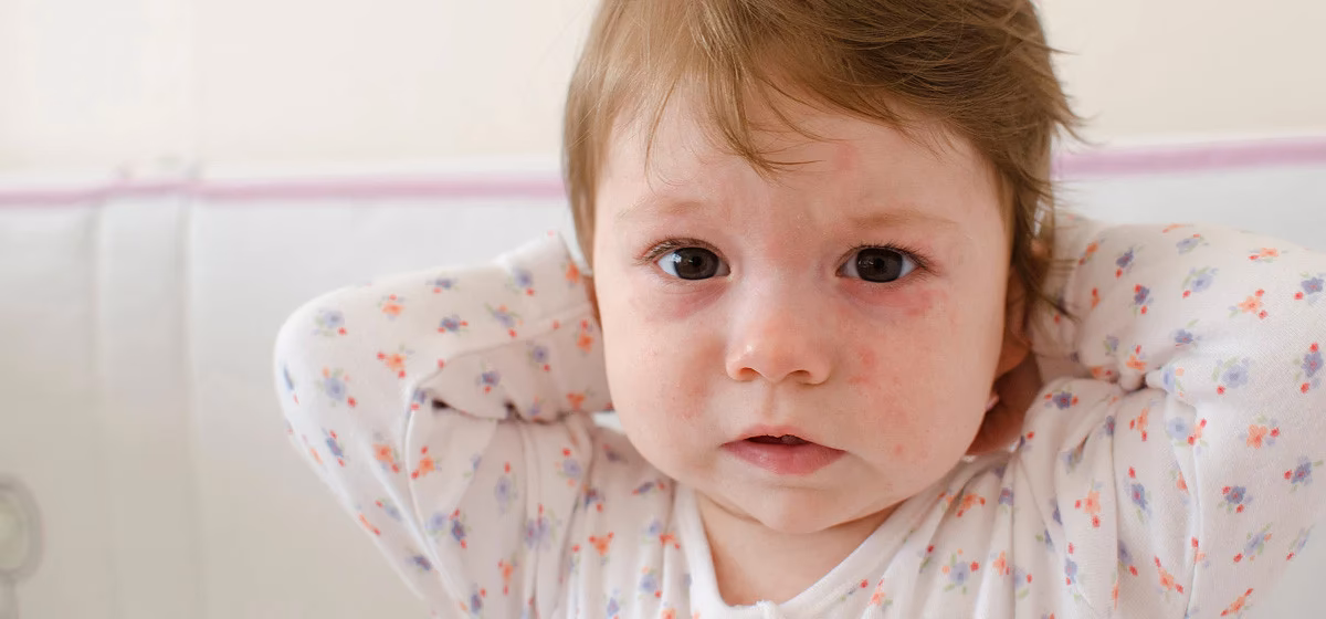 What are the symptoms of a paint allergy?