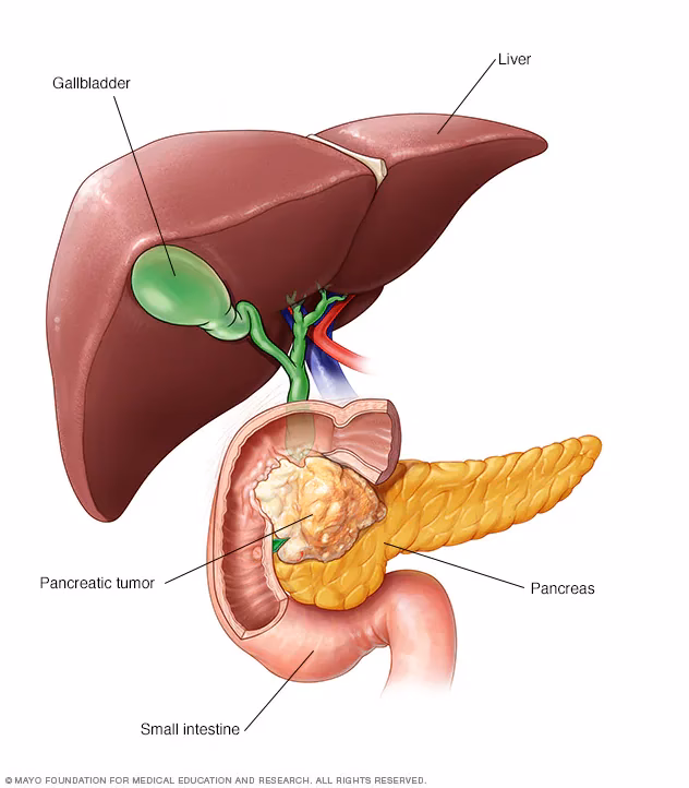 What causes pancreatic cancer?