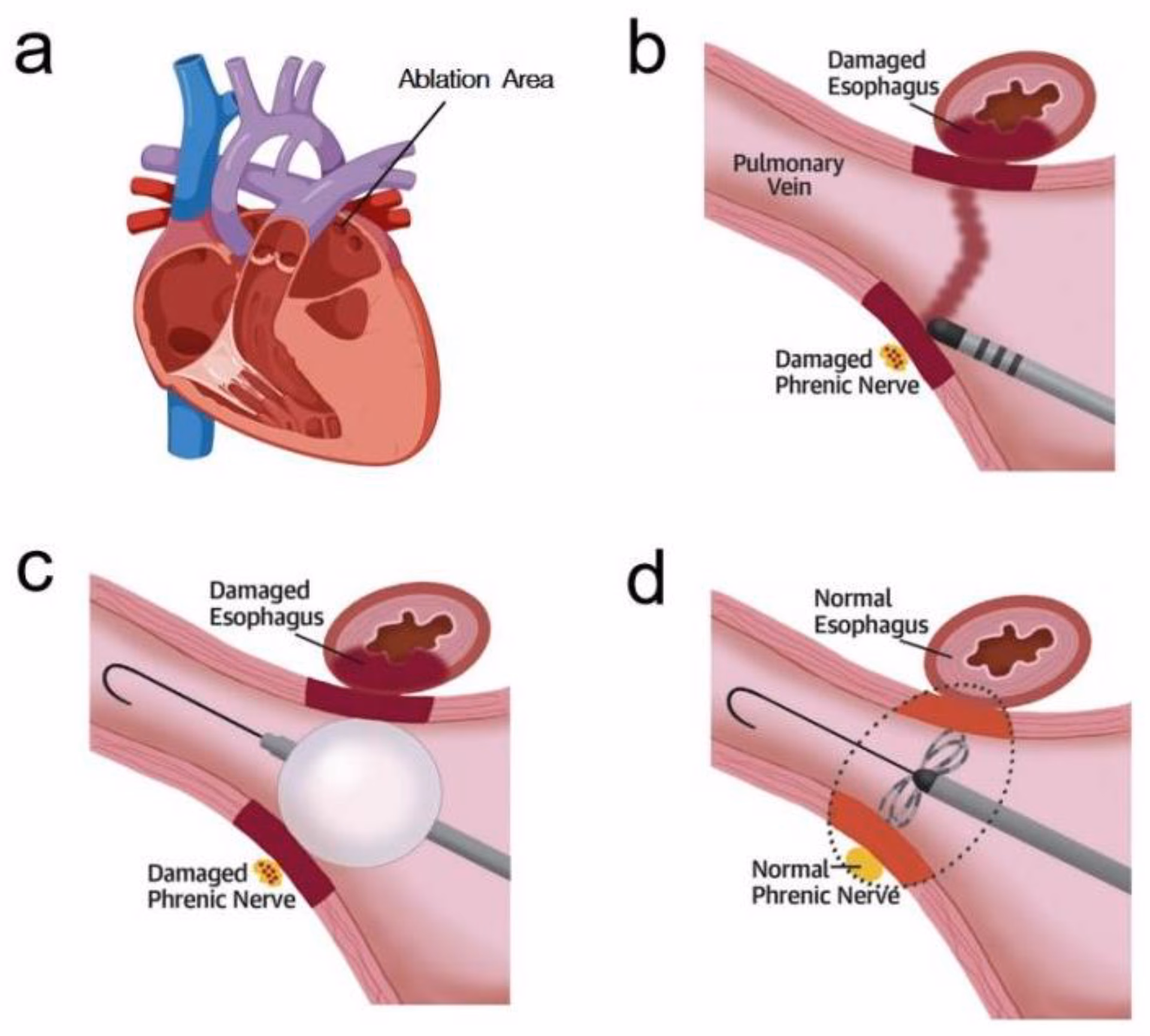 Can a patient be re-listed for a paroxysmal atrial fibrillation (PAF) surgery?