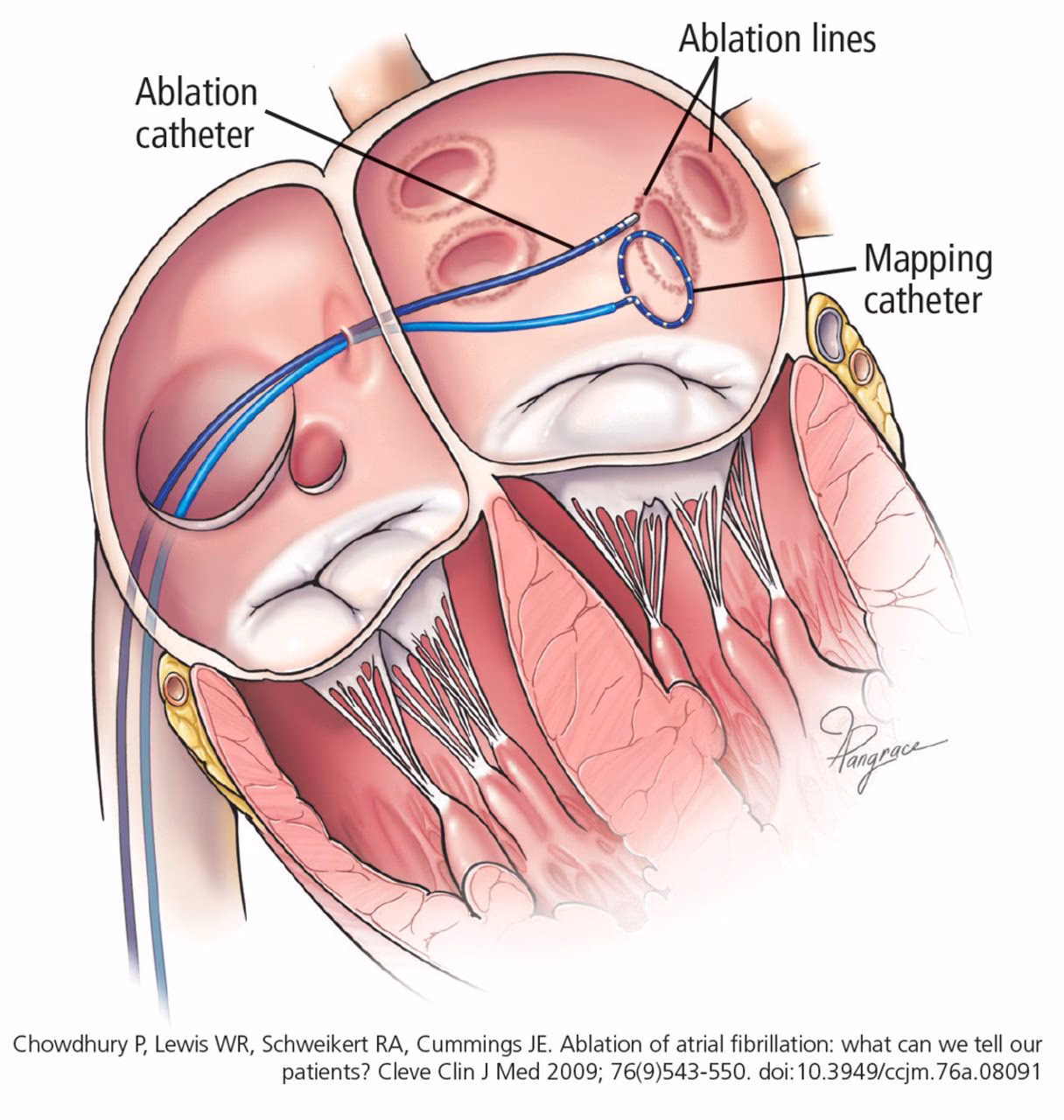 Should atrial fibrillation prophylaxis be considered in patients undergoing cardiac surgery?