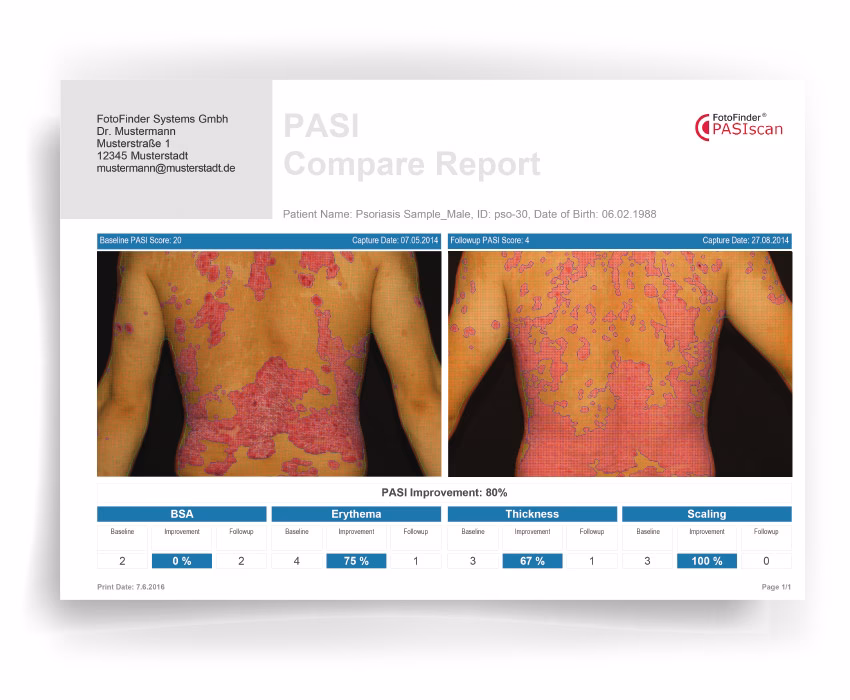 What is a good PASI score for psoriasis?