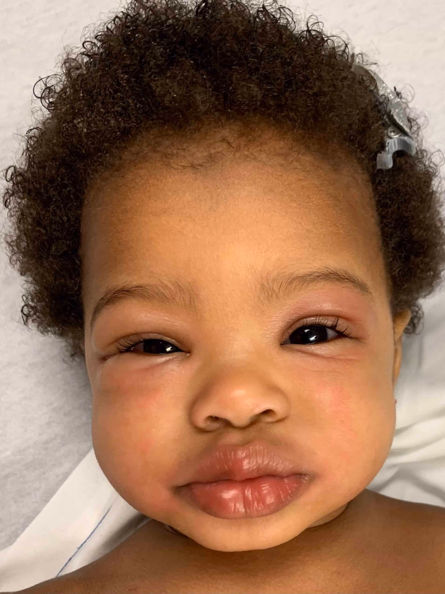 What are the symptoms of a peanut allergy in babies?