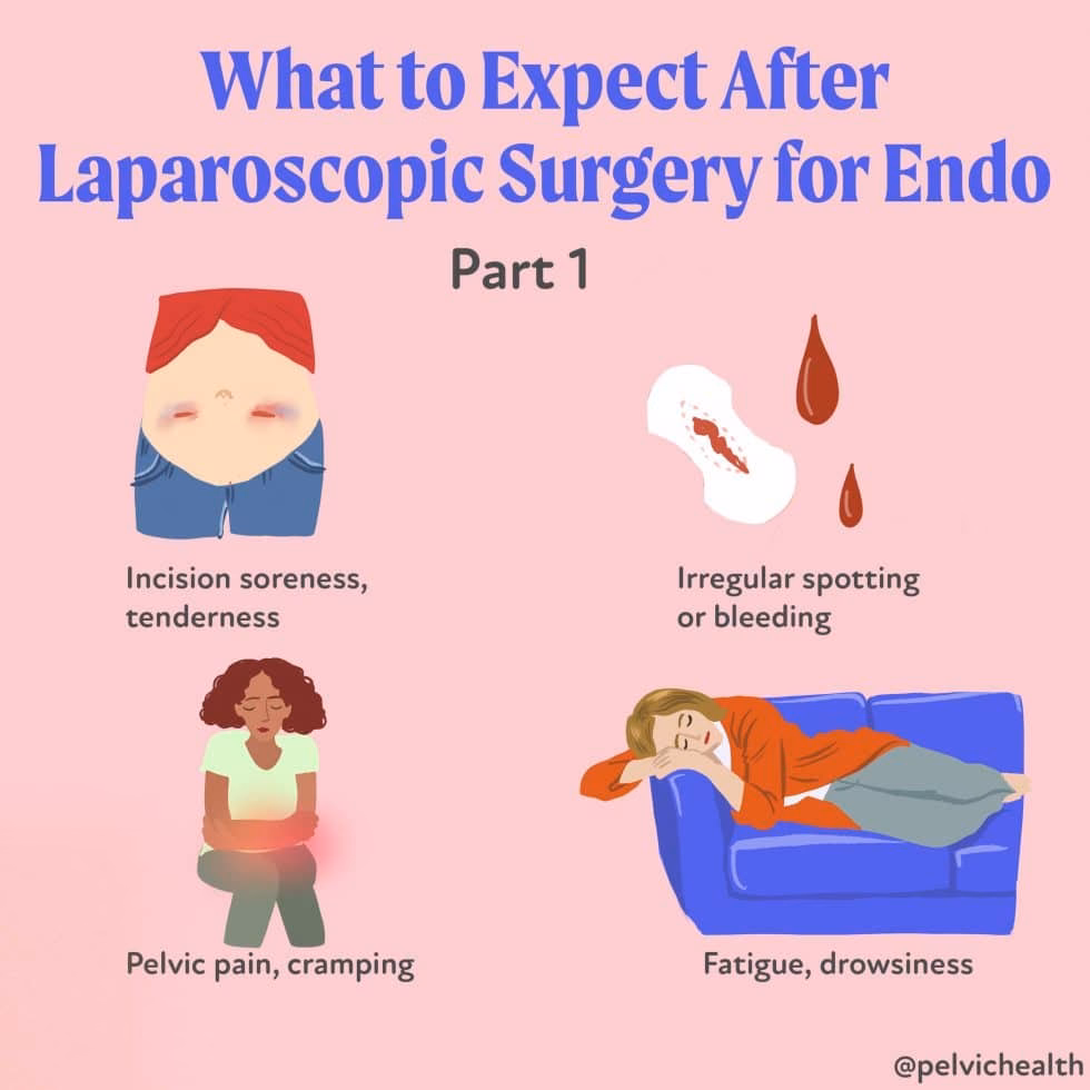 Is pelvic pain after endometriosis excision surgery normal?