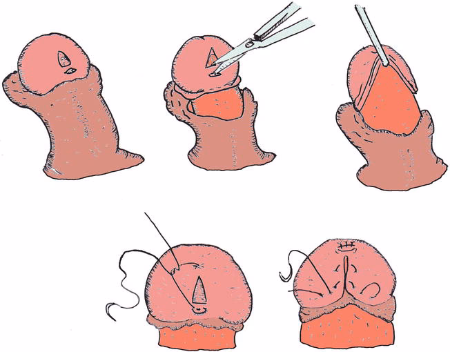 What is Diphallia (penile duplication)?