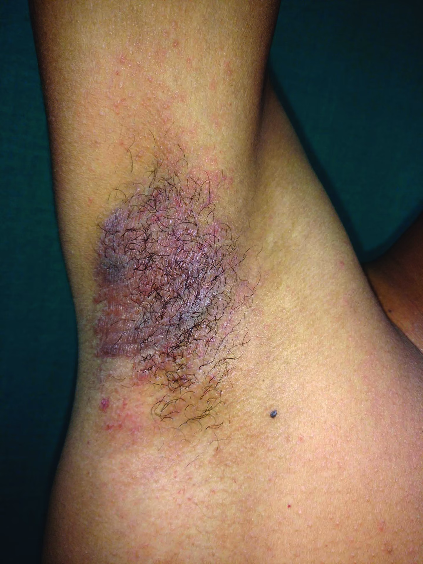 Can perfume cause allergic rhinitis?