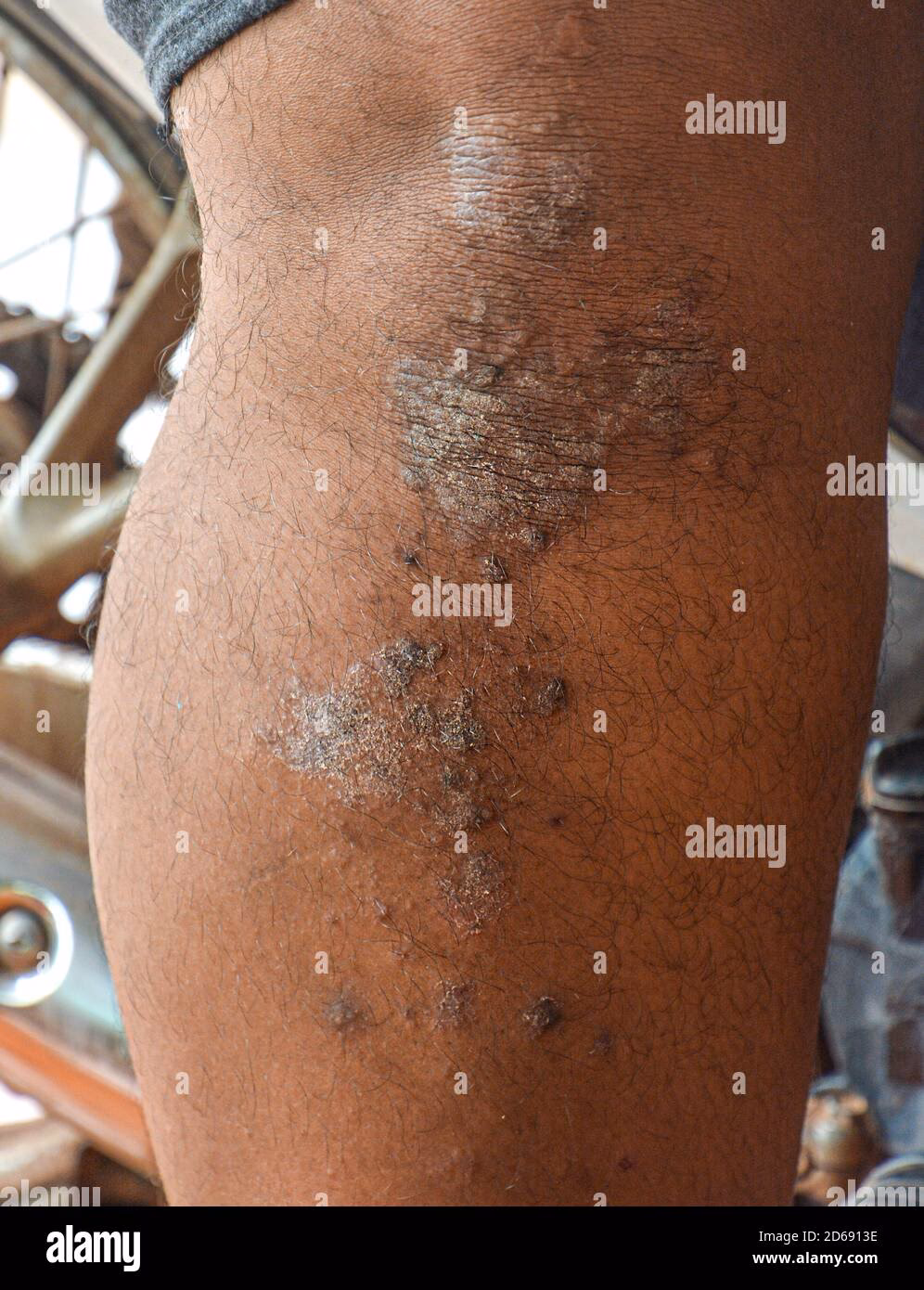 How is pesticide allergy treated?