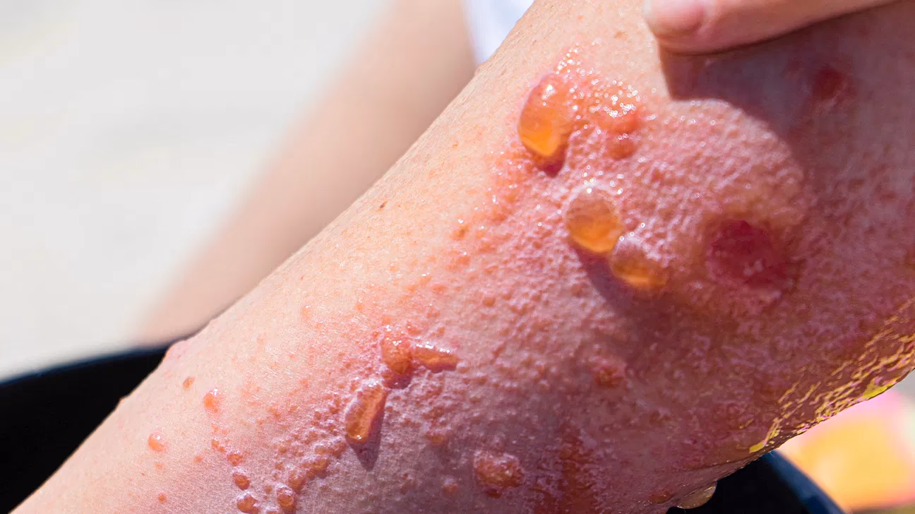 Can white petrolatum cause allergic contact dermatitis?