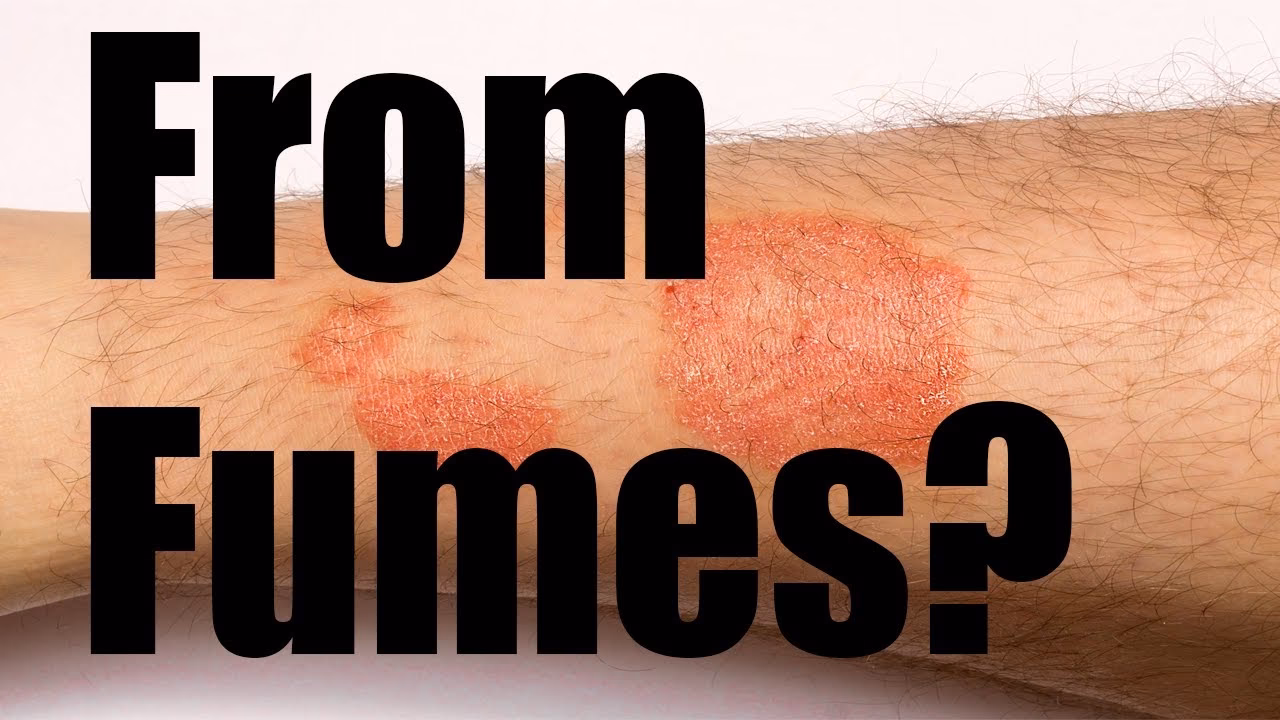 Can polymers cause allergic reactions?