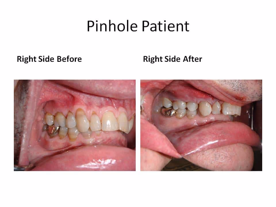 What is pinhole gum surgery?