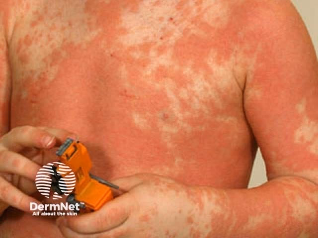 What is pityriasis rubra pilaris (PRP)?