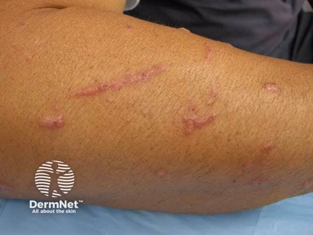 What causes allergies in New Zealand?