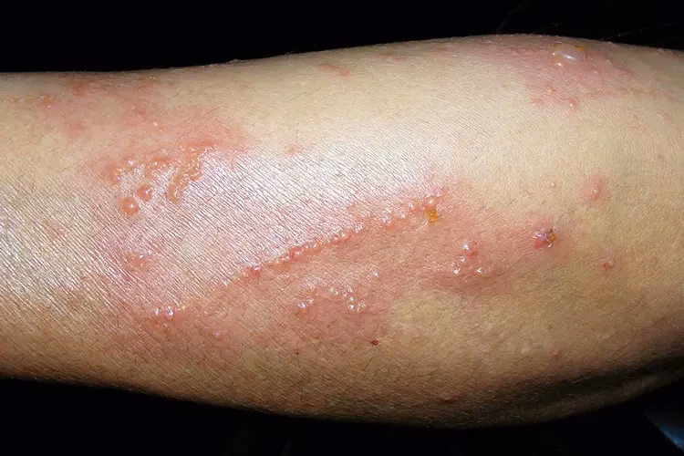 Do all flowers have pollen allergies?