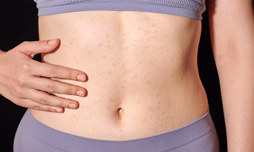 Can latex plaster cause an allergic reaction?