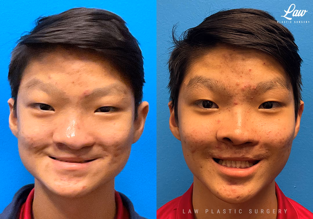 What is before & after breast augmentation?