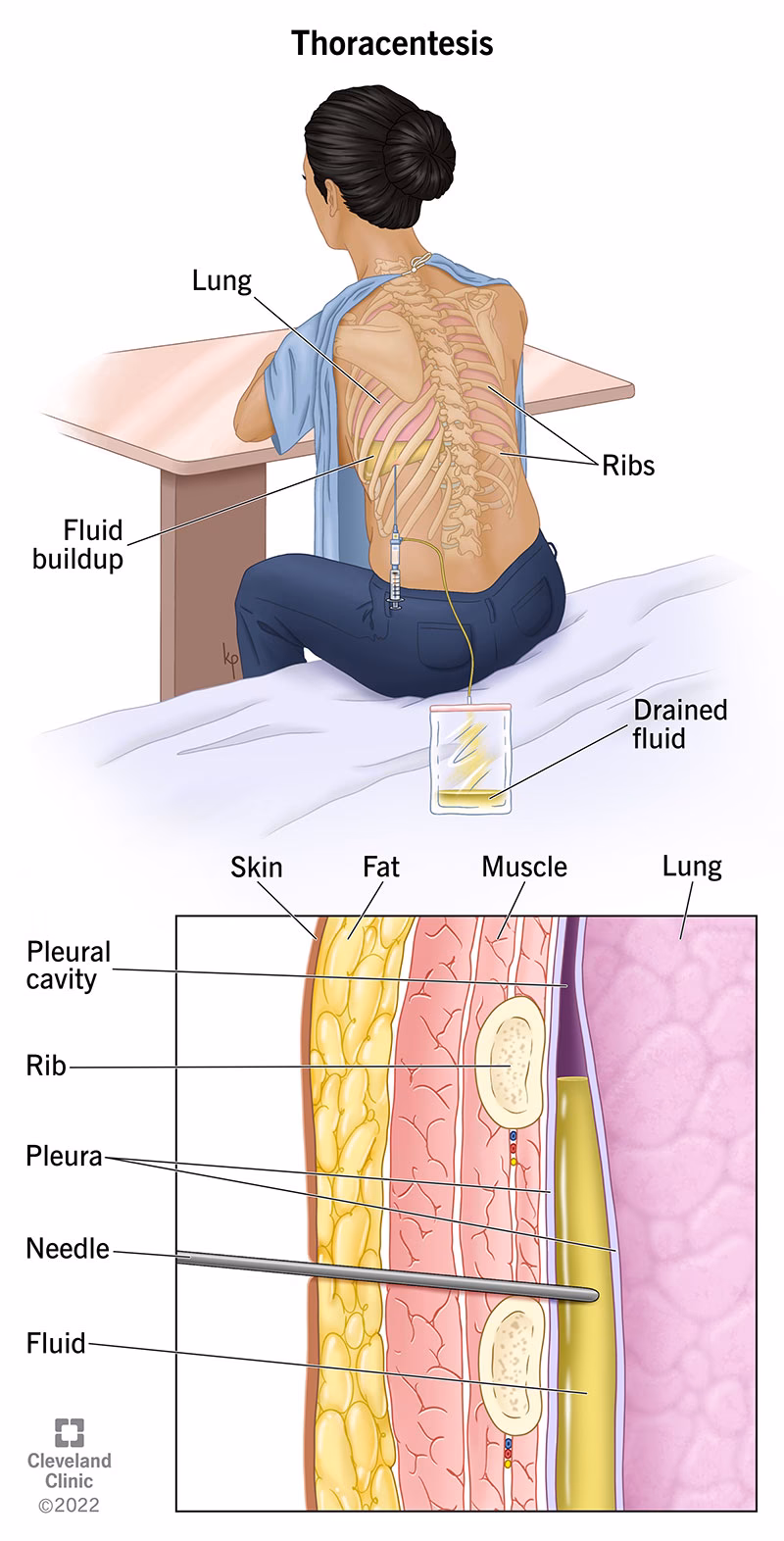Does pneumothorax need a drain?