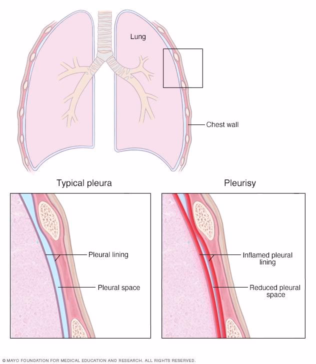 What are the symptoms of pleurisy?