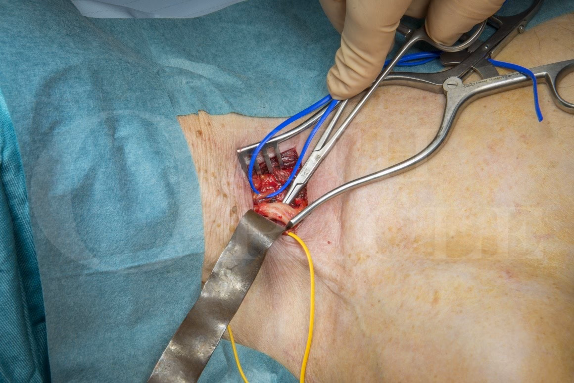 Can a brachial plexus injury be repaired?