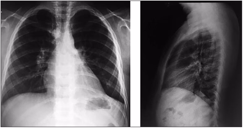 Como tratar pneumonia no bebê?