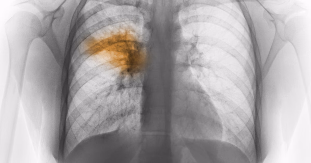 What diseases can a pneumococcal infection cause?