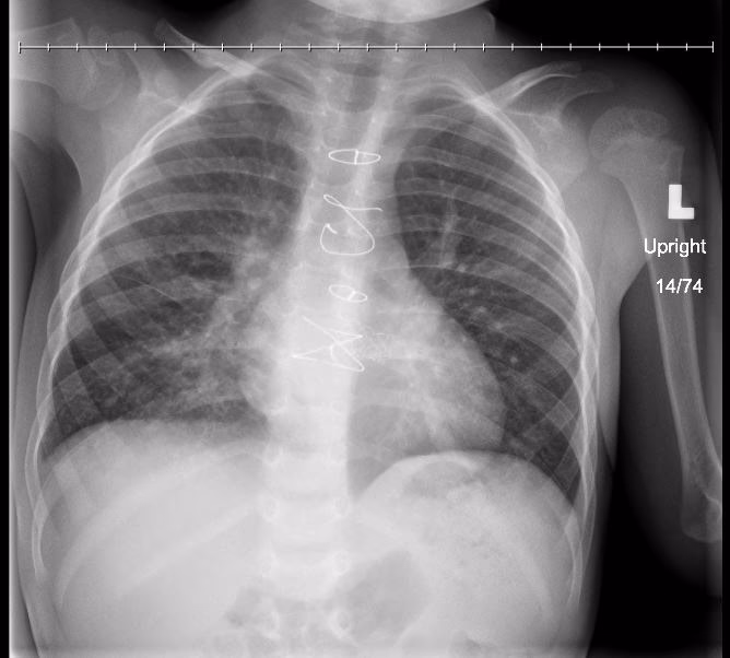 How does pneumonia affect a person's health?