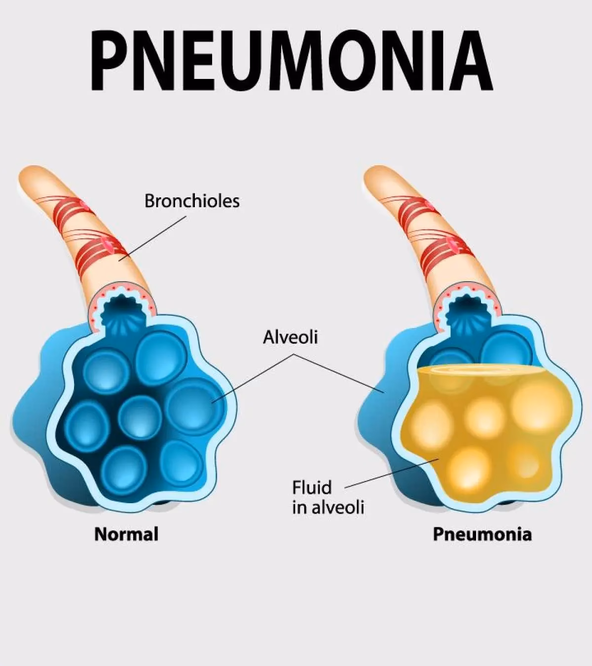 Can pregnancy cause pneumonia?