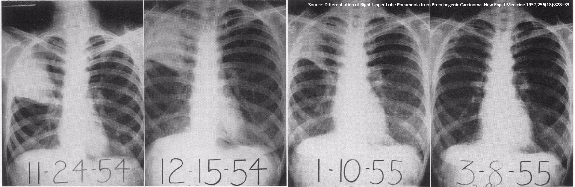 How long does bacterial pneumonia last in a child?