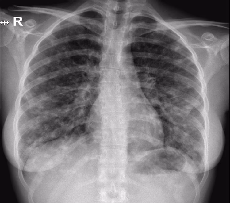What are the symptoms of bilateral pneumonia?