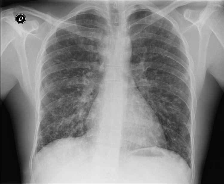 What is bilateral pneumonia?