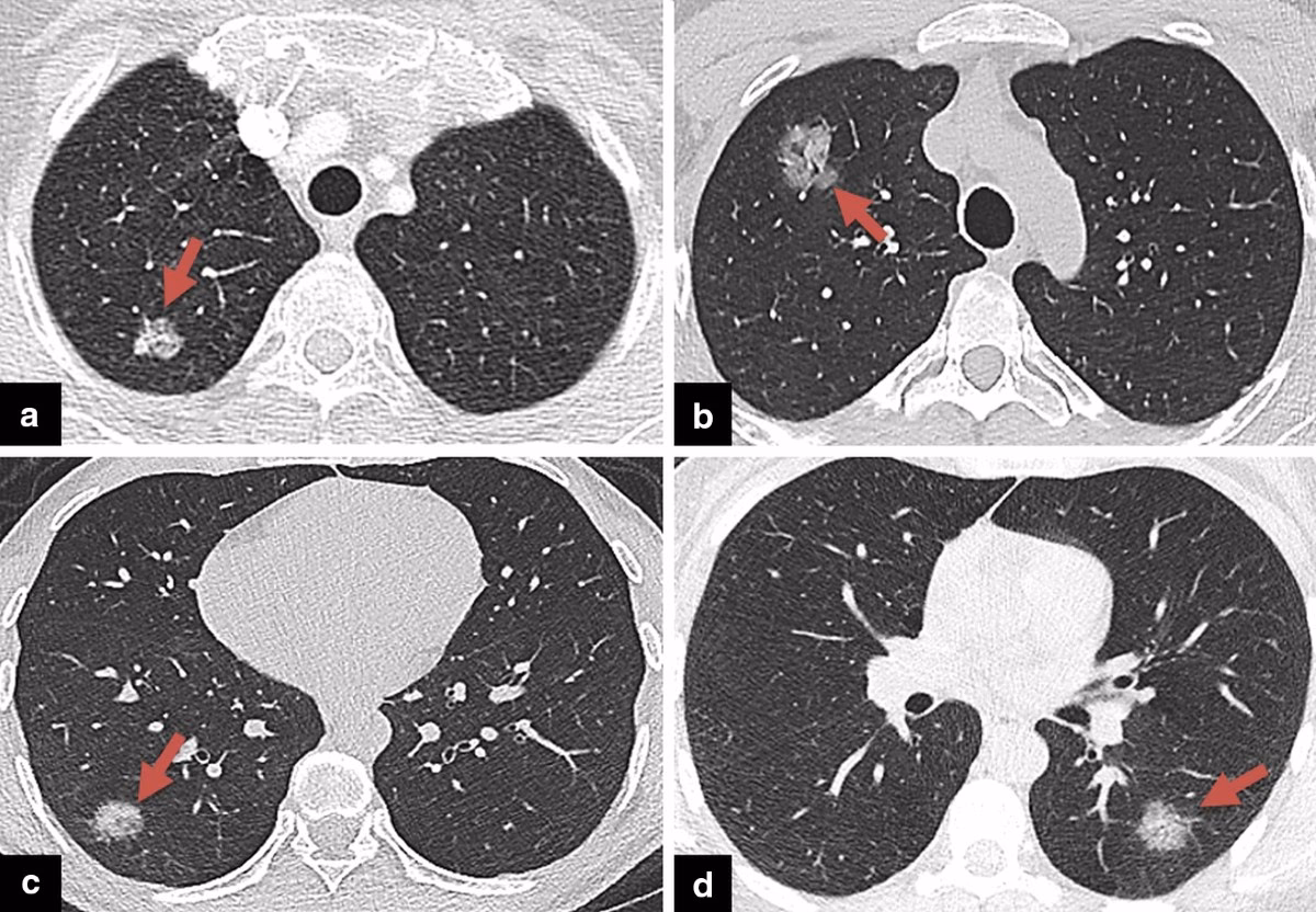 What does a chest CT show in a patient with Legionella pneumonia?
